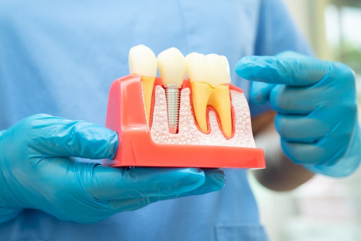 Dental implant model showing tooth replacement with crown and metal post in jawbone structure.