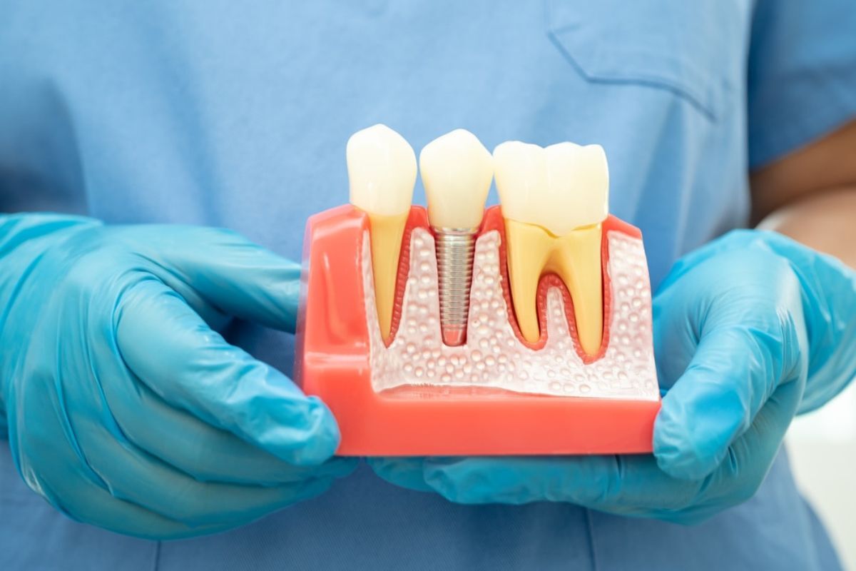 Dental implant model showing tooth replacement with crown and metal post in jawbone structure.