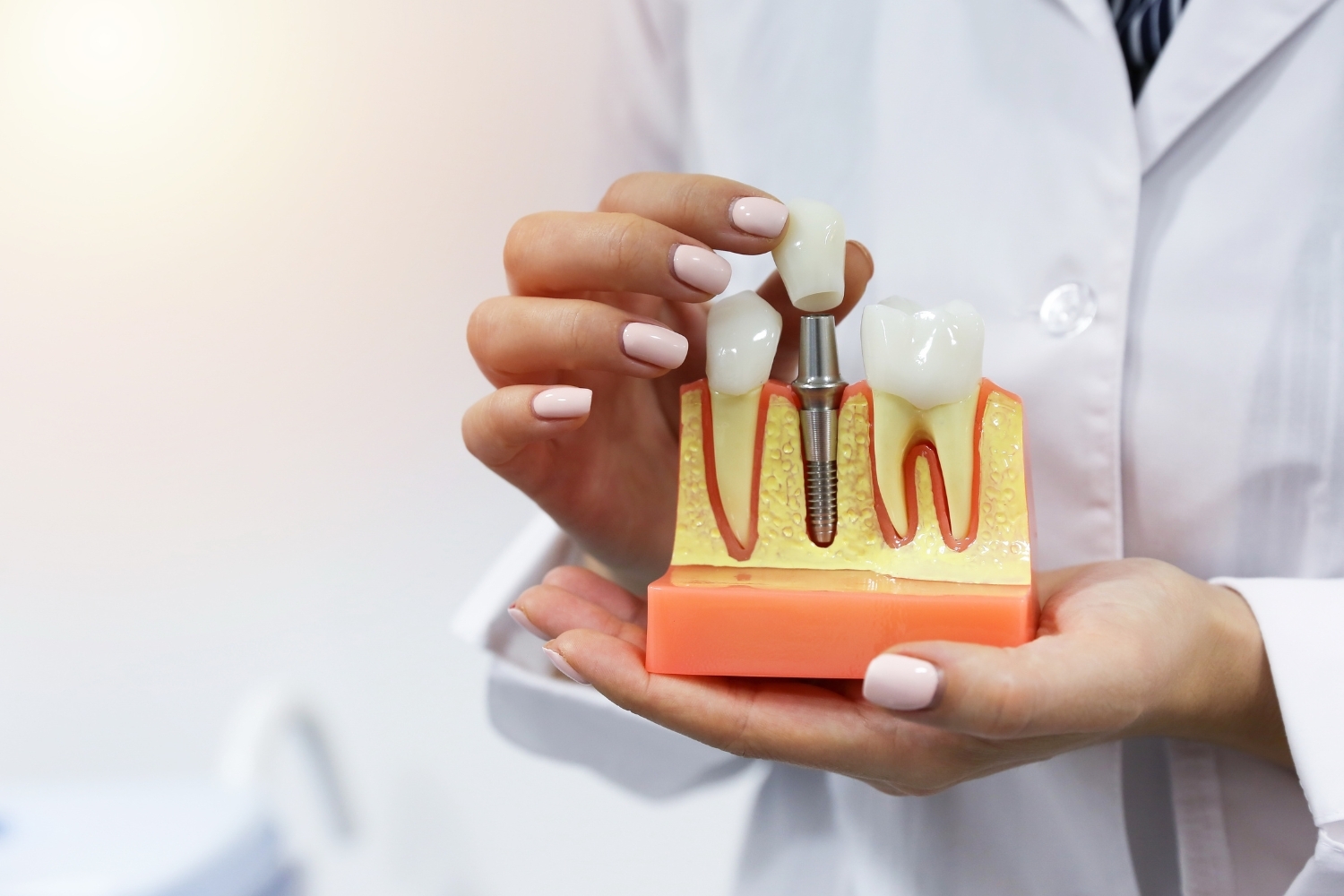 Smart Dental Implants Are Dentists Using Them Yet Dentist holding dental implant model showing tooth replacement with titanium screw and crown.