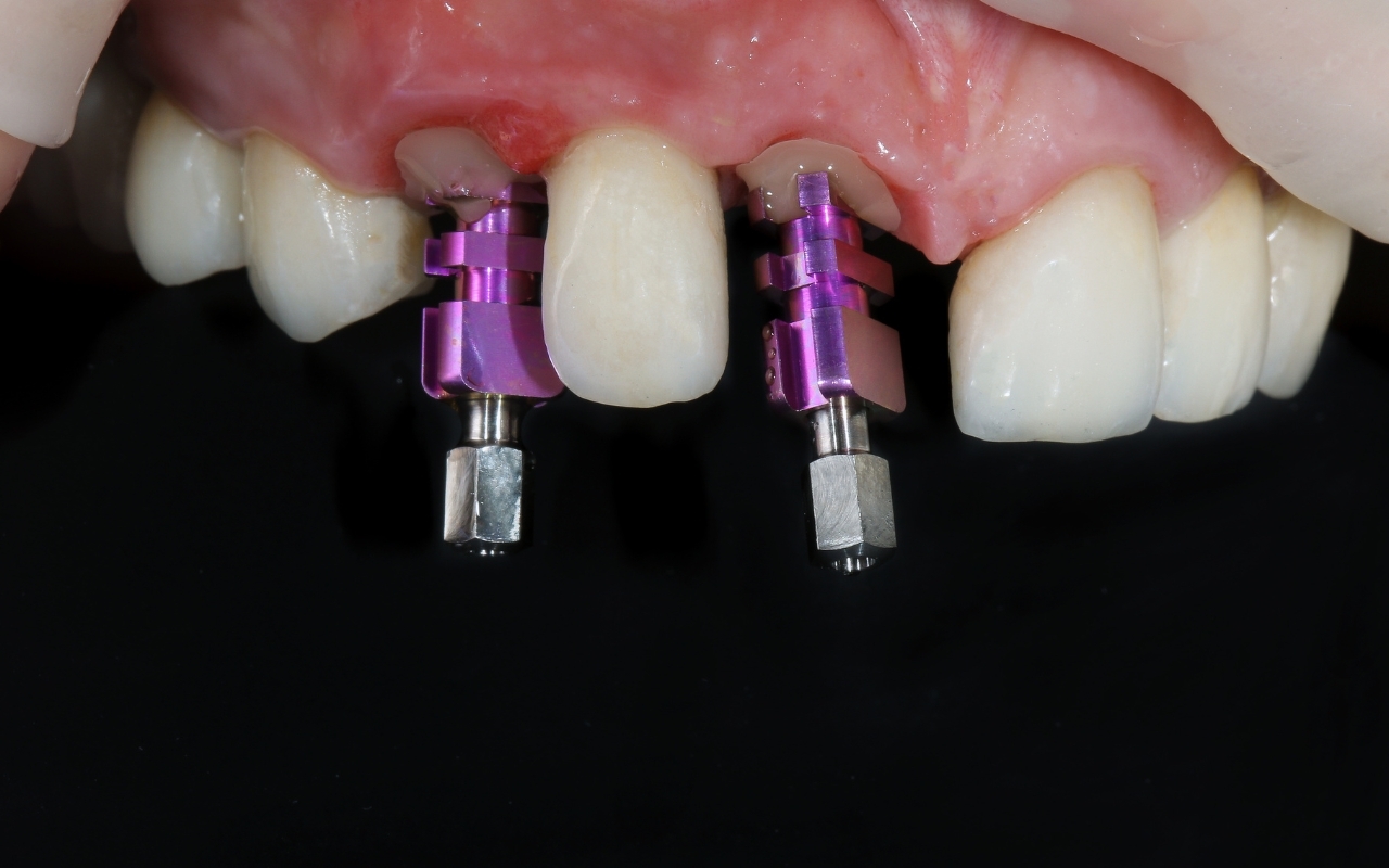 Dental implant abutments with purple abutment guides placed in patient's upper anterior teeth.