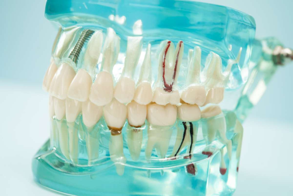 Are Root Canals Painful_ A Duxbury Dentist’s Perspective Dental model displaying tooth anatomy with nerve and blood vessel structures for root canal education.