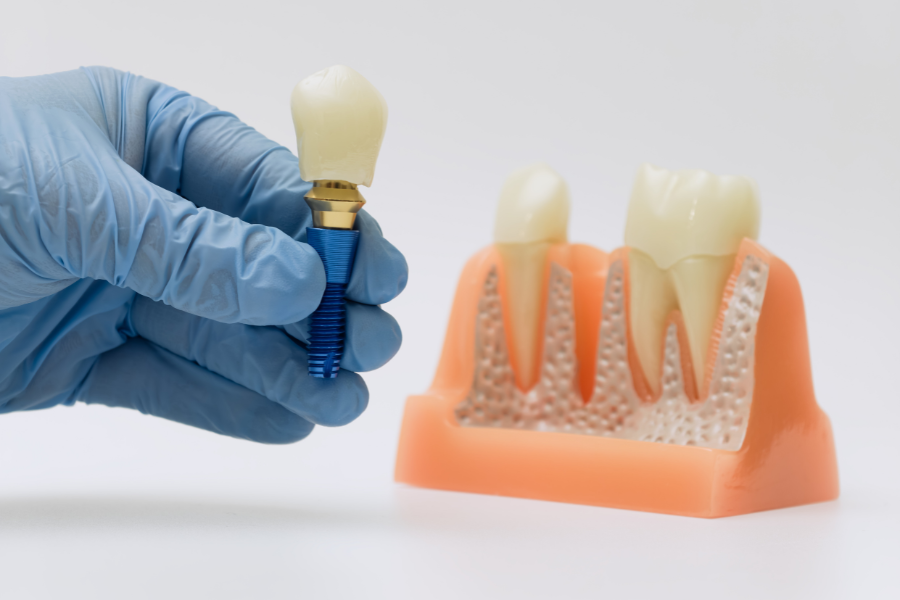 Dental implant model showing tooth replacement with titanium screw and crown components.
