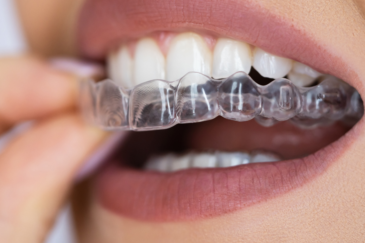 How Custom Night Guards Help Relieve TMJ Symptoms Person inserting a clear custom night guard over upper teeth to relieve TMJ symptoms.