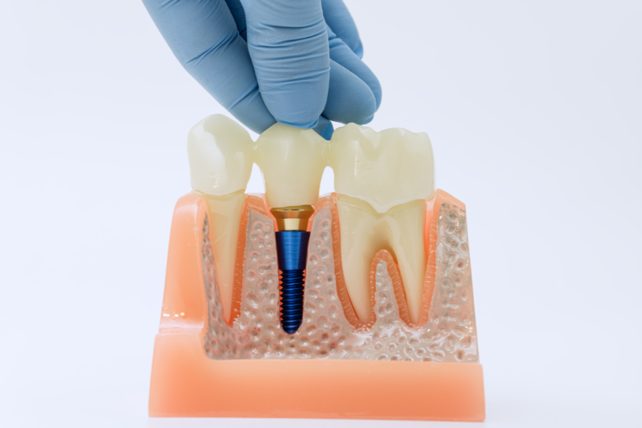 Dental implant model showing titanium screw placement in jawbone between natural teeth.