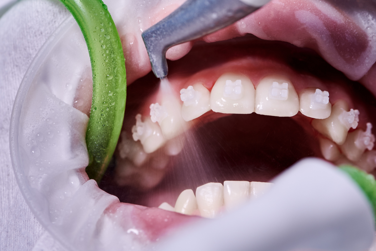 Deep Cleaning (Scaling and Root Planing) Dentist performing scaling and root planing treatment on patient's teeth during deep cleaning procedure.