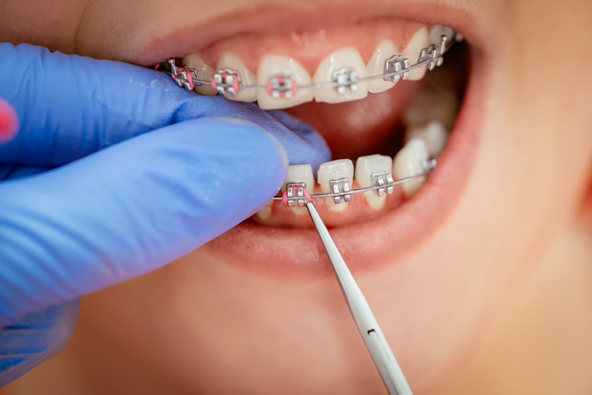 Full-Mouth Restoration in Duxbury Full-Mouth Restoration in Duxbury